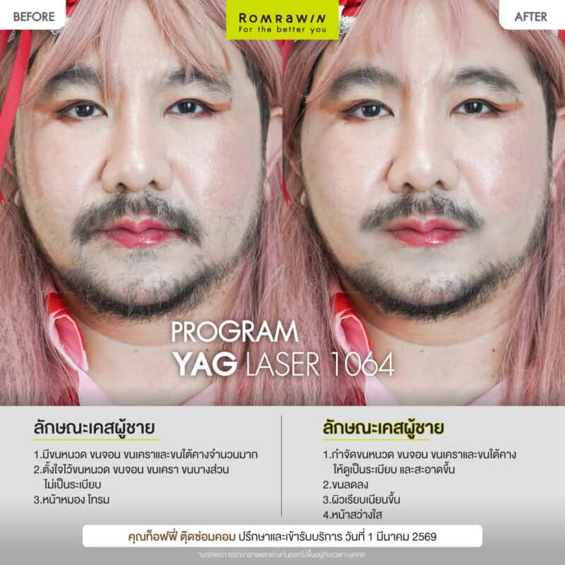 ผลลัพธ์ขึ้นอยู่กับแต่ละบุคคล