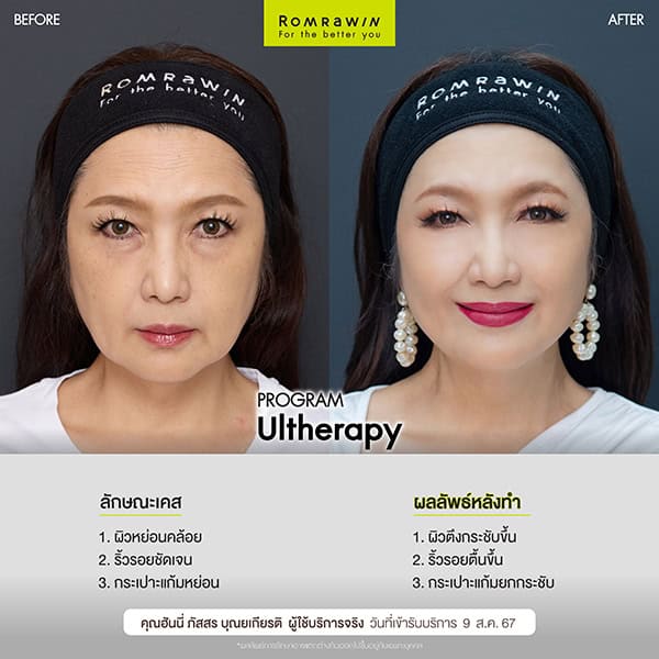 ผลลัพธ์ขึ้นอยู่กับแต่ละบุคคล