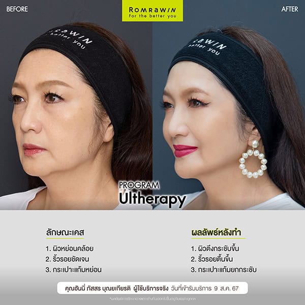 ผลลัพธ์ขึ้นอยู่กับแต่ละบุคคล