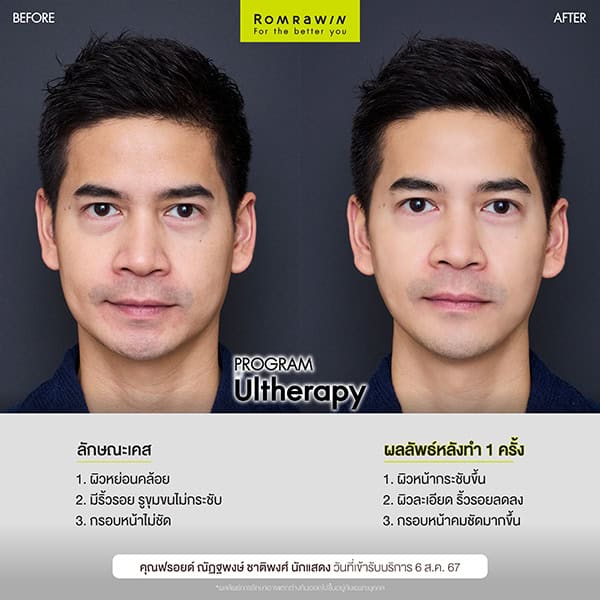 ผลลัพธ์ขึ้นอยู่กับแต่ละบุคคล