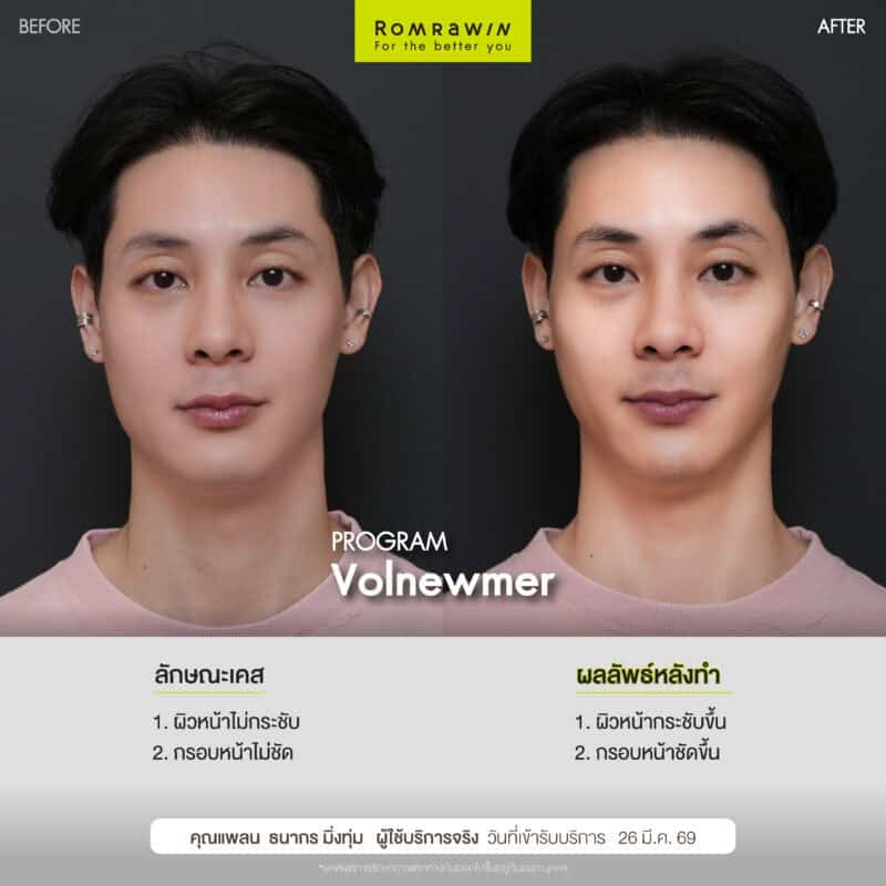 ผลลัพธ์ขึ้นอยู่กับแต่ละบุคคล