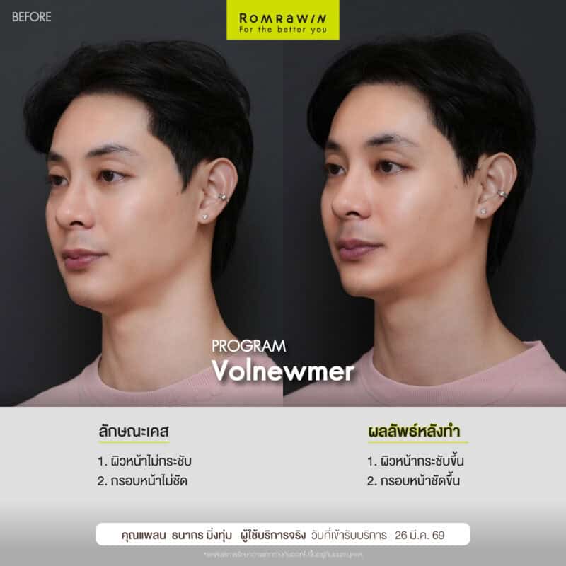 ผลลัพธ์ขึ้นอยู่กับแต่ละบุคคล