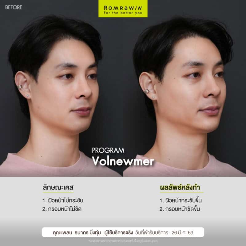 ผลลัพธ์ขึ้นอยู่กับแต่ละบุคคล