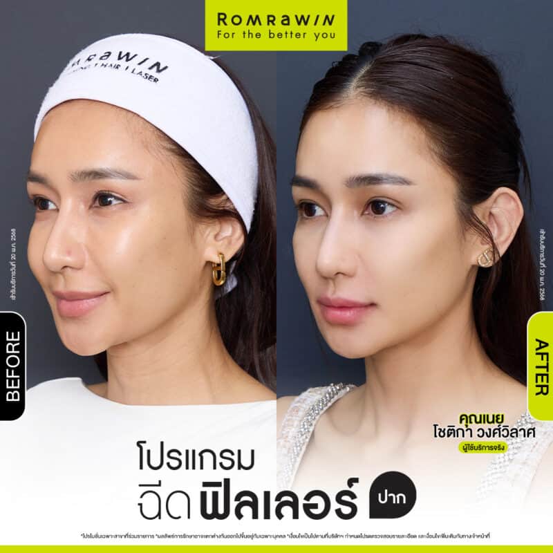 ผลลัพธ์ขึ้นอยู่กับแต่ละบุคคล