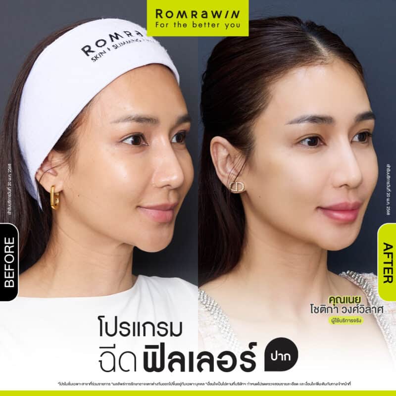 ผลลัพธ์ขึ้นอยู่กับแต่ละบุคคล
