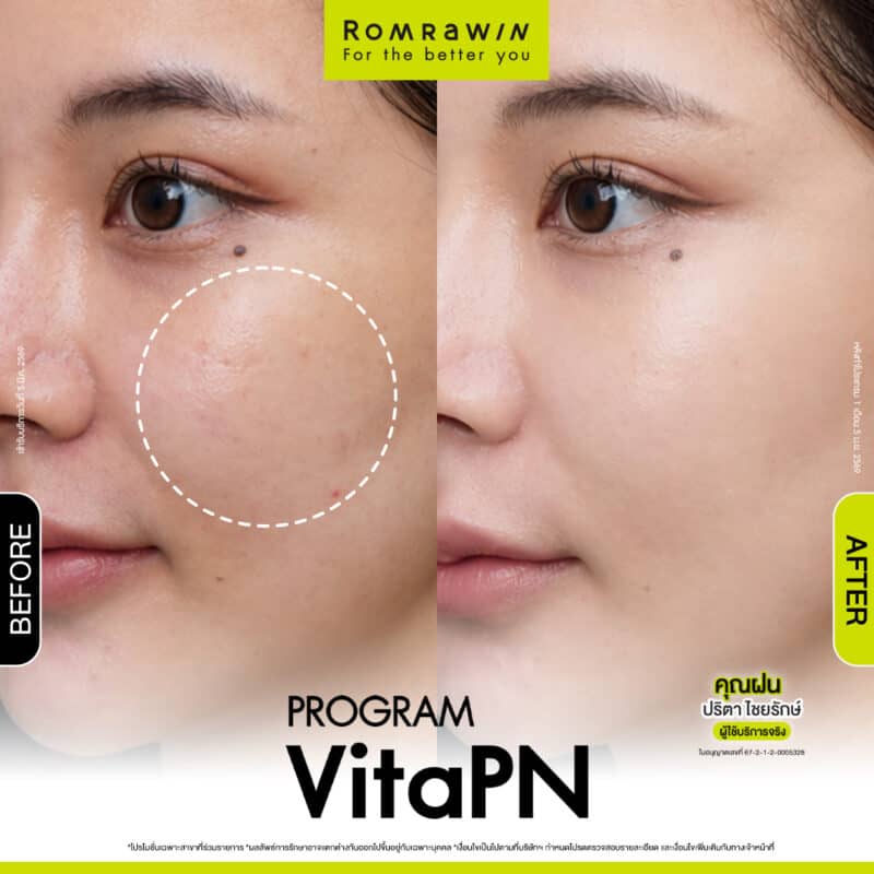 ผลลัพธ์ขึ้นอยู่กับแต่ละบุคคล
