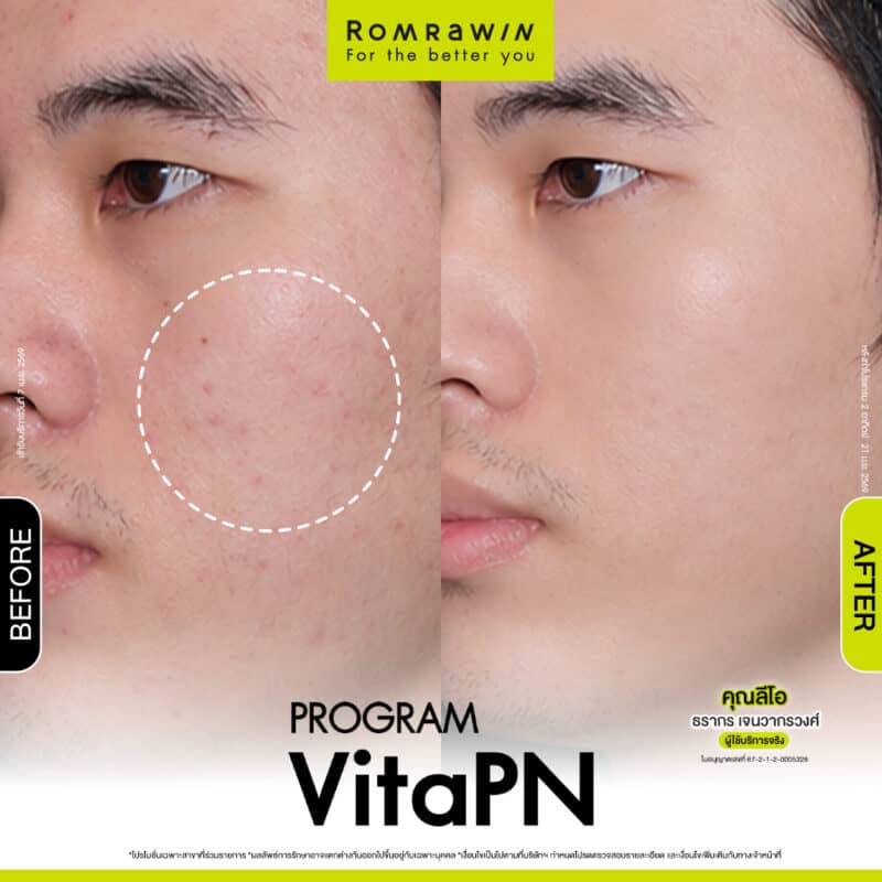 ผลลัพธ์ขึ้นอยู่กับแต่ละบุคคล