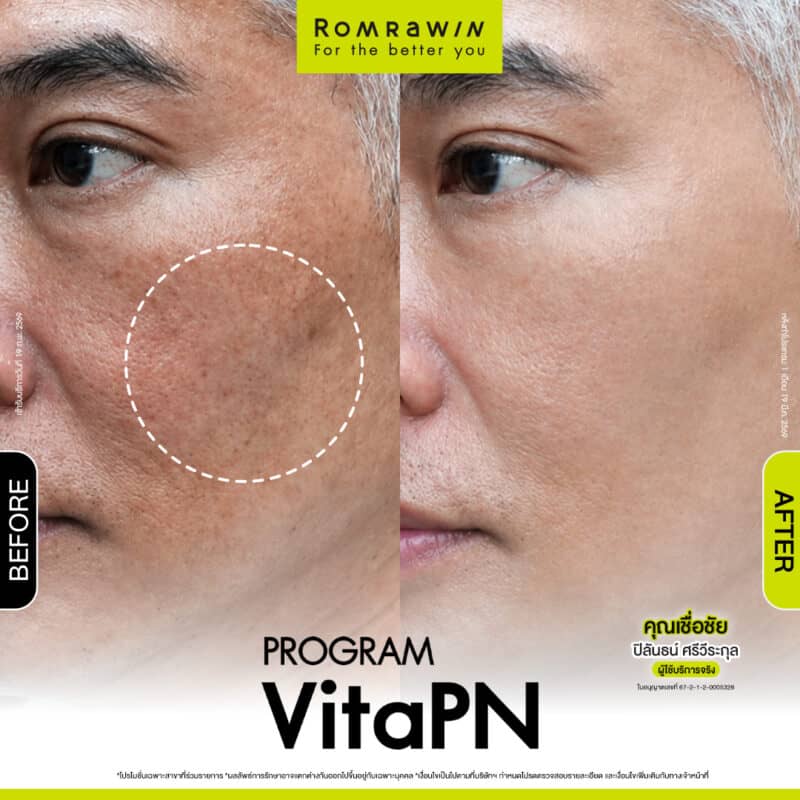ผลลัพธ์ขึ้นอยู่กับแต่ละบุคคล