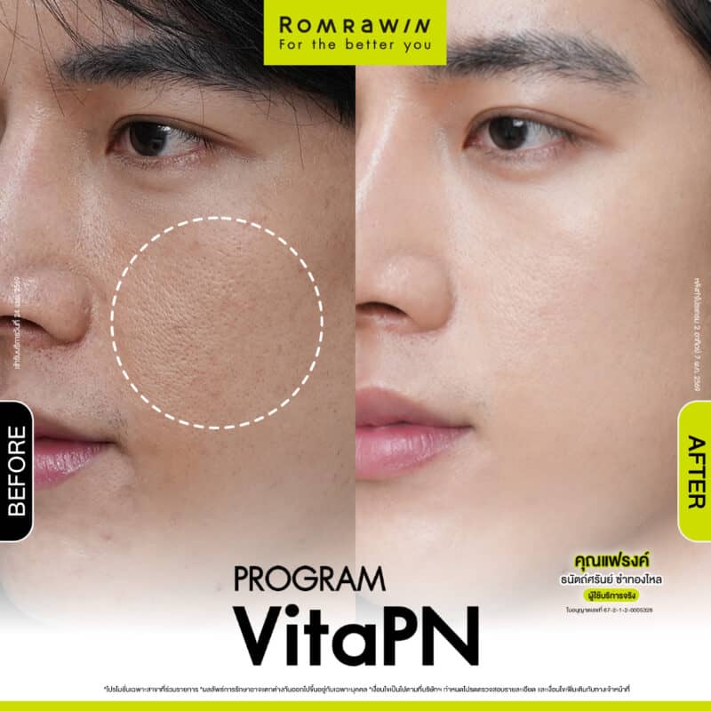 ผลลัพธ์ขึ้นอยู่กับแต่ละบุคคล