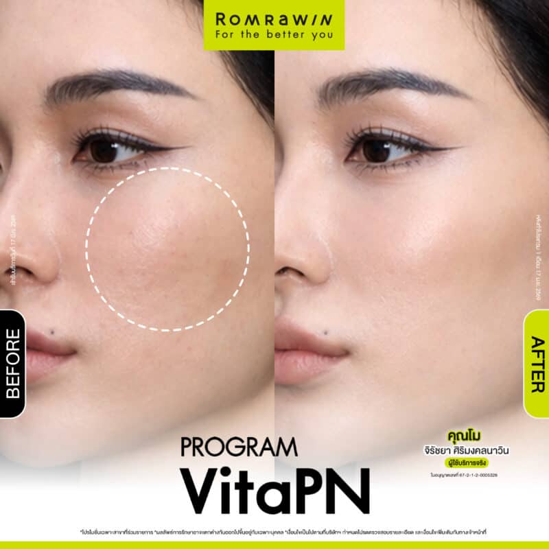 ผลลัพธ์ขึ้นอยู่กับแต่ละบุคคล