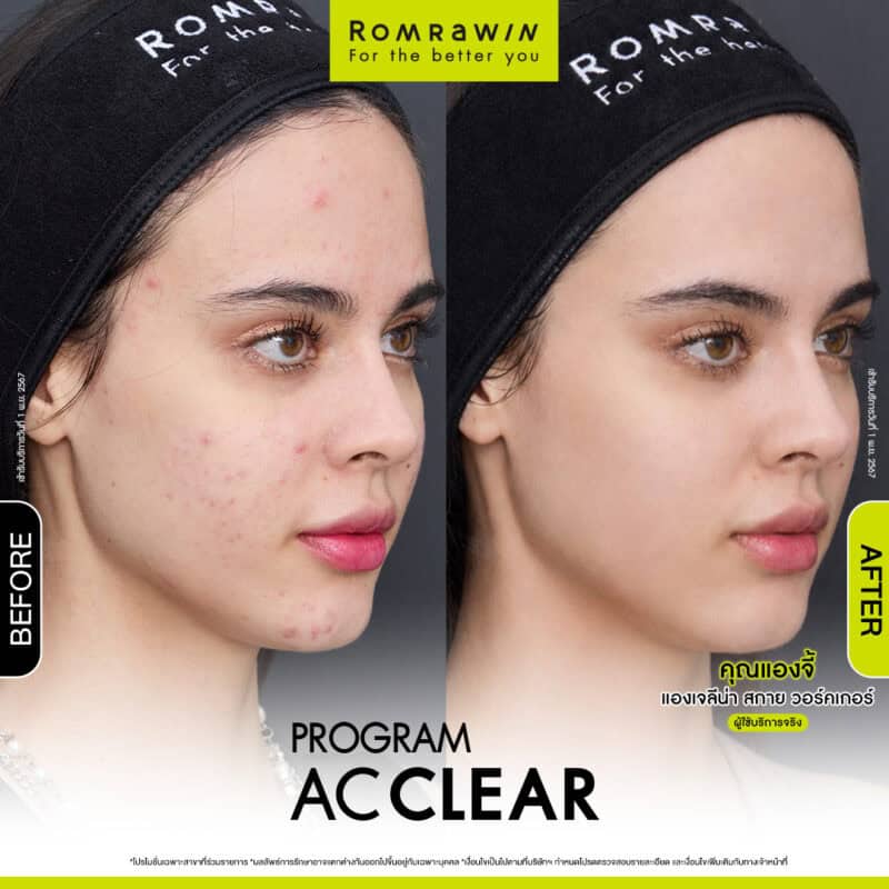 AC CLEAR Acne Treatment Program