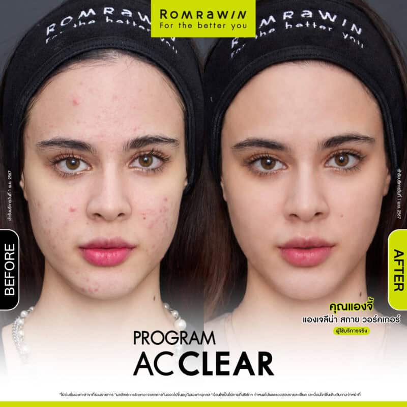 AC CLEAR Acne Treatment Program