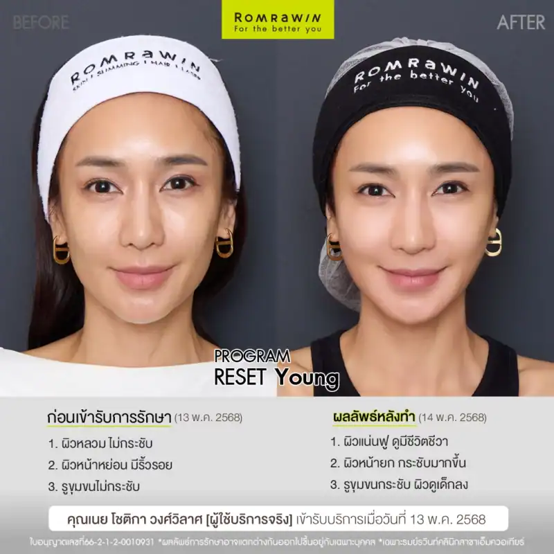 ผลลัพธ์ขึ้นอยู่กับแต่ละบุคคล