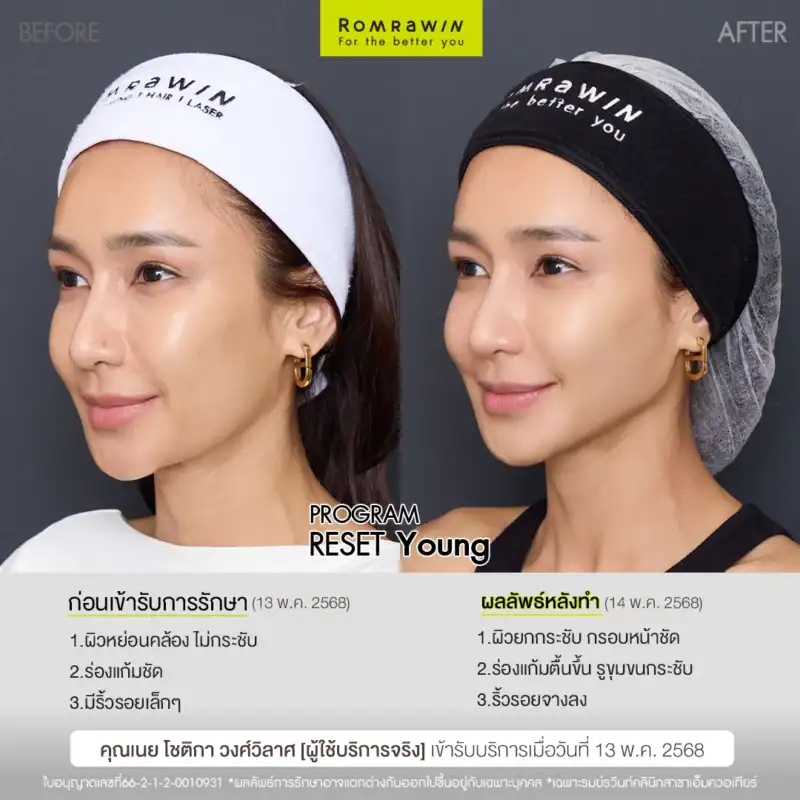 ผลลัพธ์ขึ้นอยู่กับแต่ละบุคคล