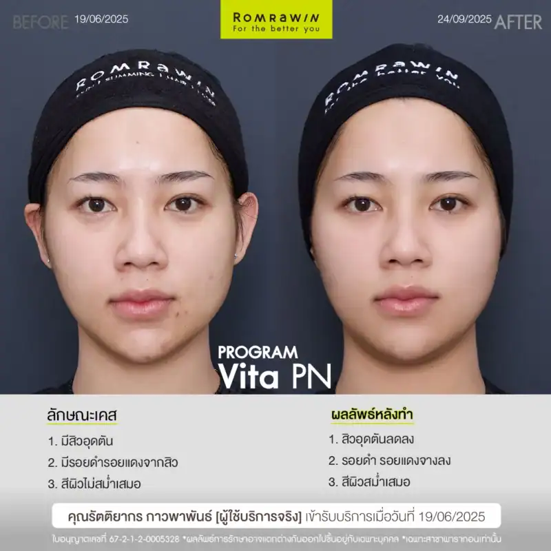 ผลลัพธ์ขึ้นอยู่กับแต่ละบุคคล