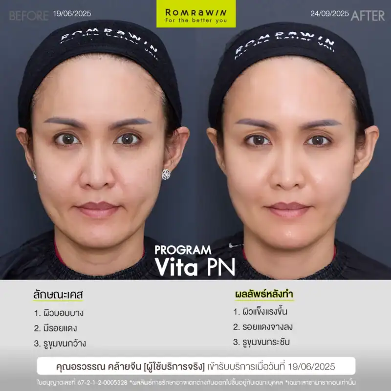 ผลลัพธ์ขึ้นอยู่กับแต่ละบุคคล
