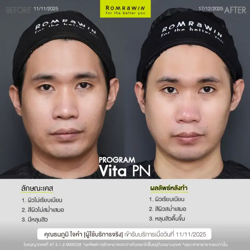 ผลลัพธ์ขึ้นอยู่กับแต่ละบุคคล