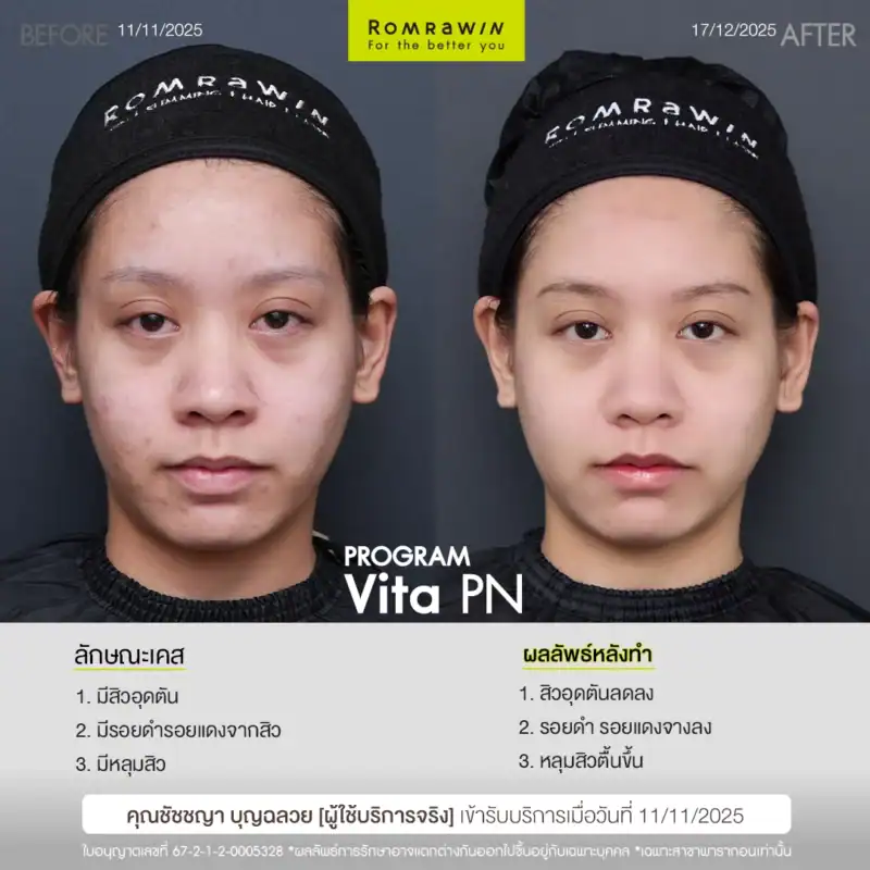 ผลลัพธ์ขึ้นอยู่กับแต่ละบุคคล