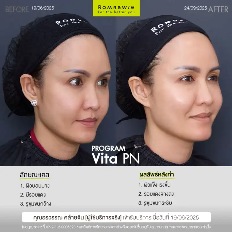 ผลลัพธ์ขึ้นอยู่กับแต่ละบุคคล