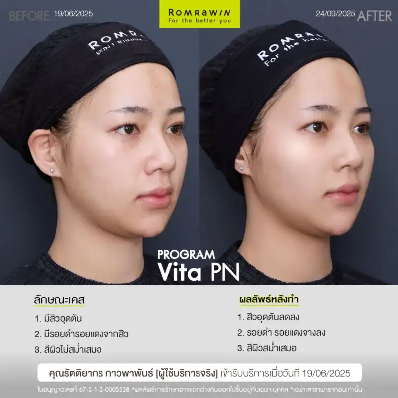 ผลลัพธ์ขึ้นอยู่กับแต่ละบุคคล