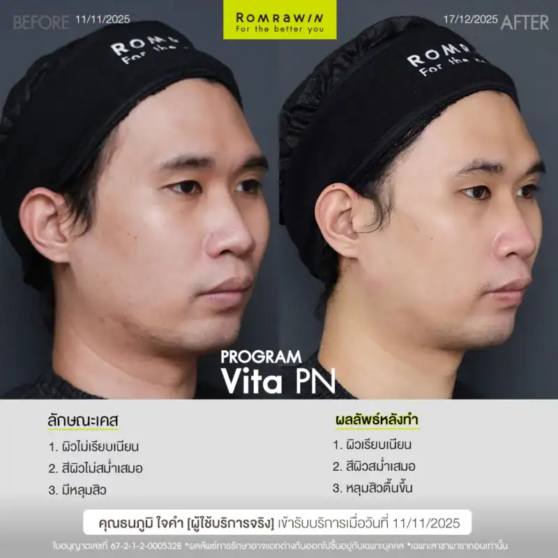 ผลลัพธ์ขึ้นอยู่กับแต่ละบุคคล
