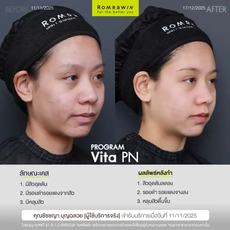 ผลลัพธ์ขึ้นอยู่กับแต่ละบุคคล