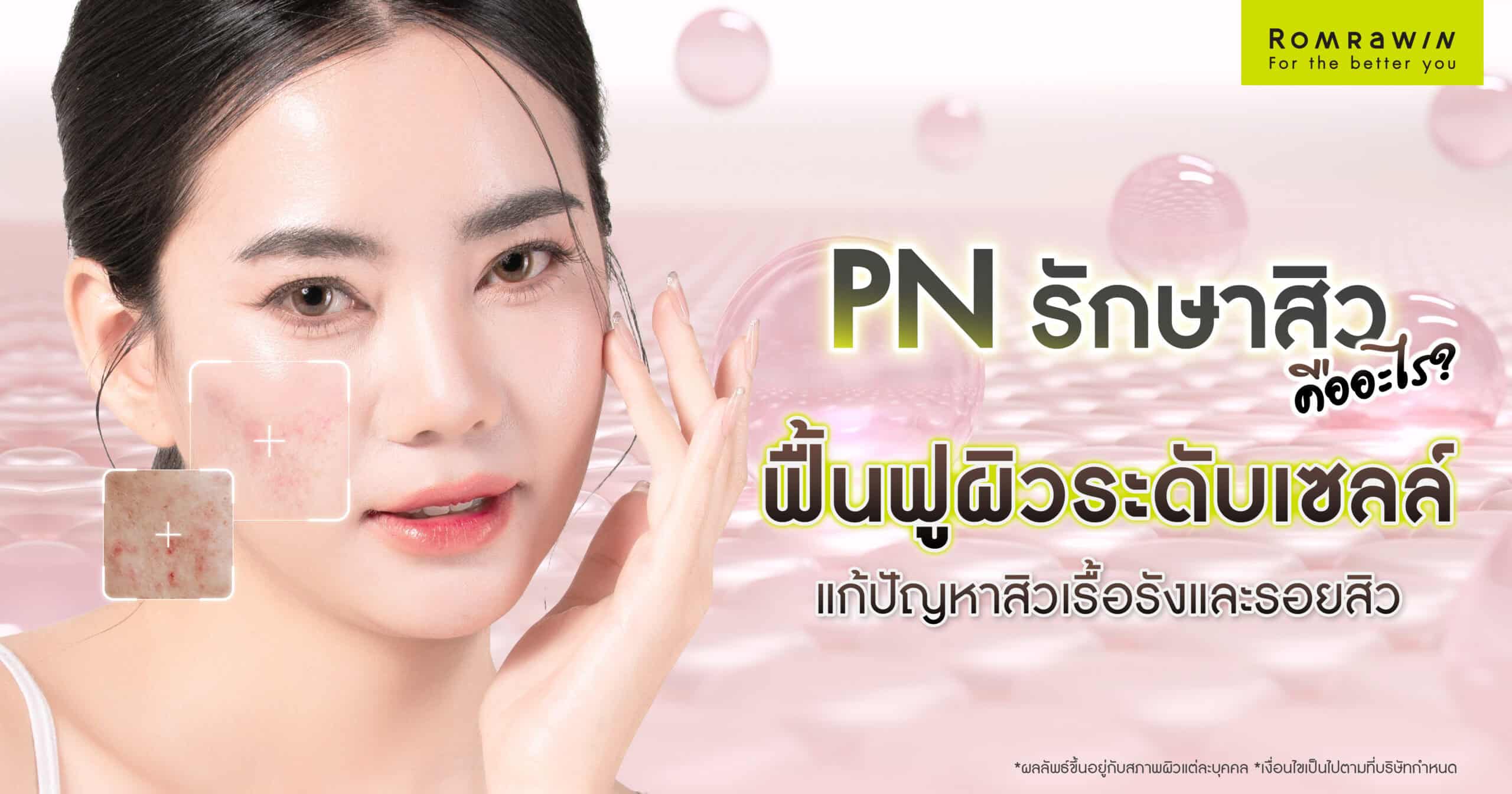 PN รักษาสิว