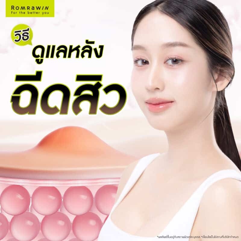 วิธีดูแลผิวหลังฉีดสิว