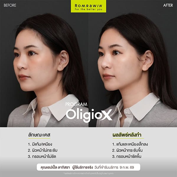 ผลลัพธ์ขึ้นอยู่กับแต่ละบุคคล