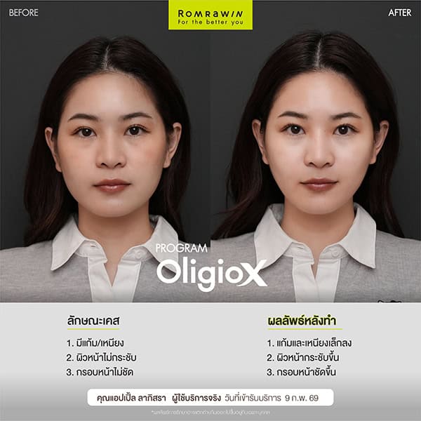 ผลลัพธ์ขึ้นอยู่กับแต่ละบุคคล