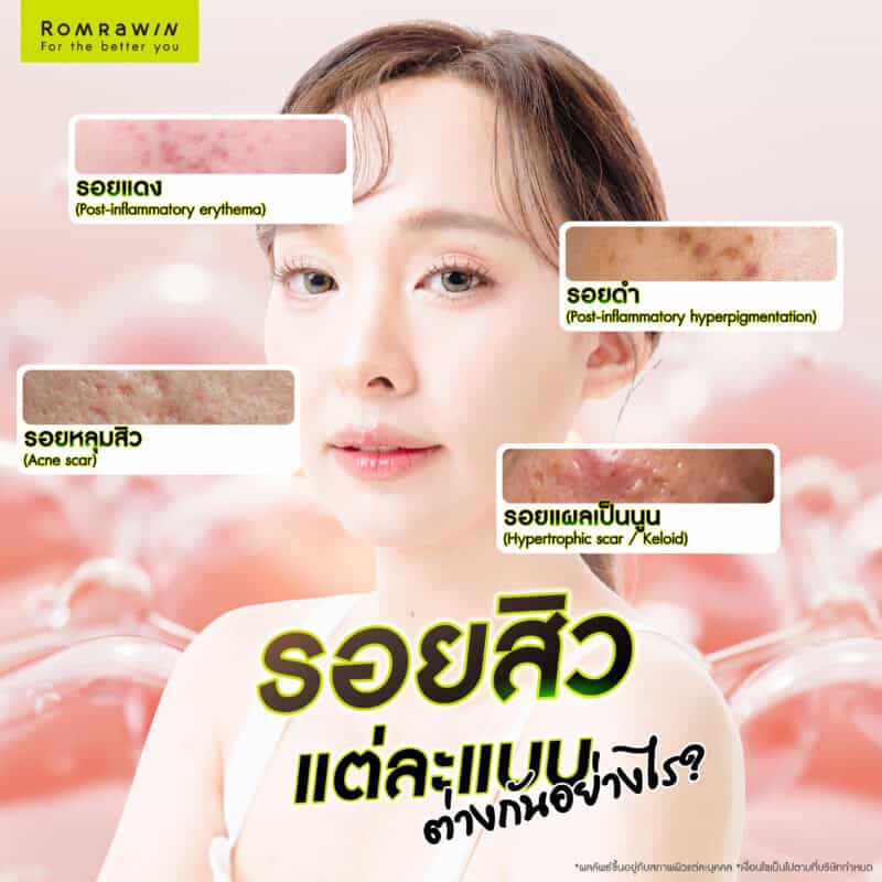 รอยสิวแต่ละแบบ ต่างกันอย่างไร