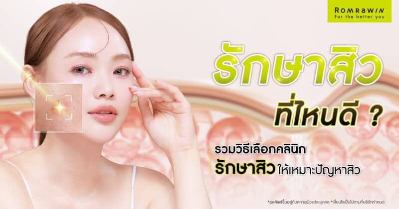 รักษาสิวที่ไหนดี
