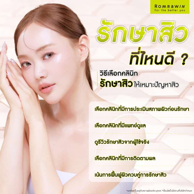 รักษาสิวที่ไหนดี? วิธีเลือกคลินิกรักษาสิวให้เหมาะกับผิว