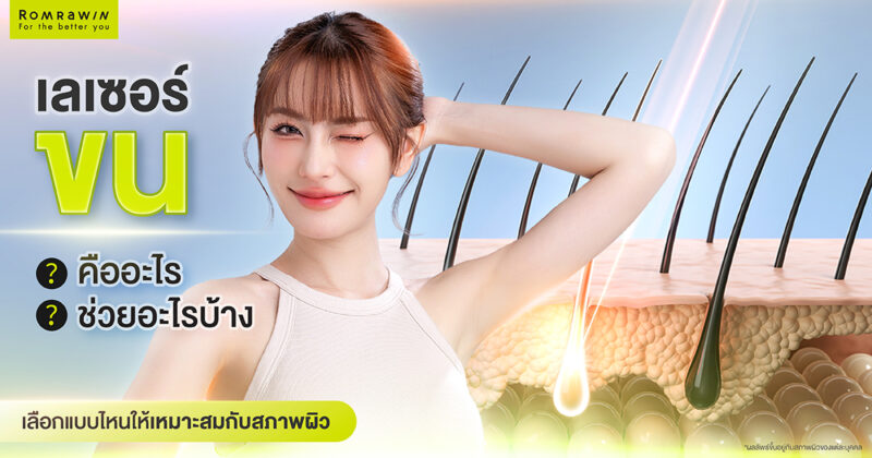 เลเซอร์ขน
