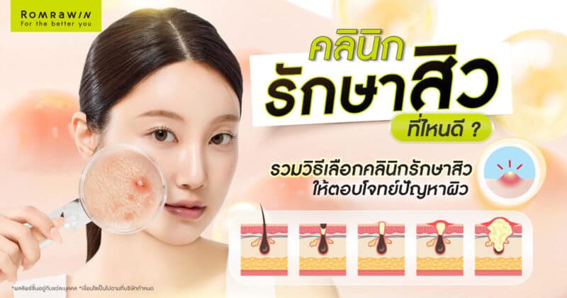 คลินิกรักษาสิว