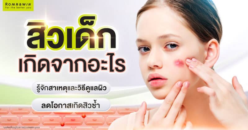 สิวเด็ก