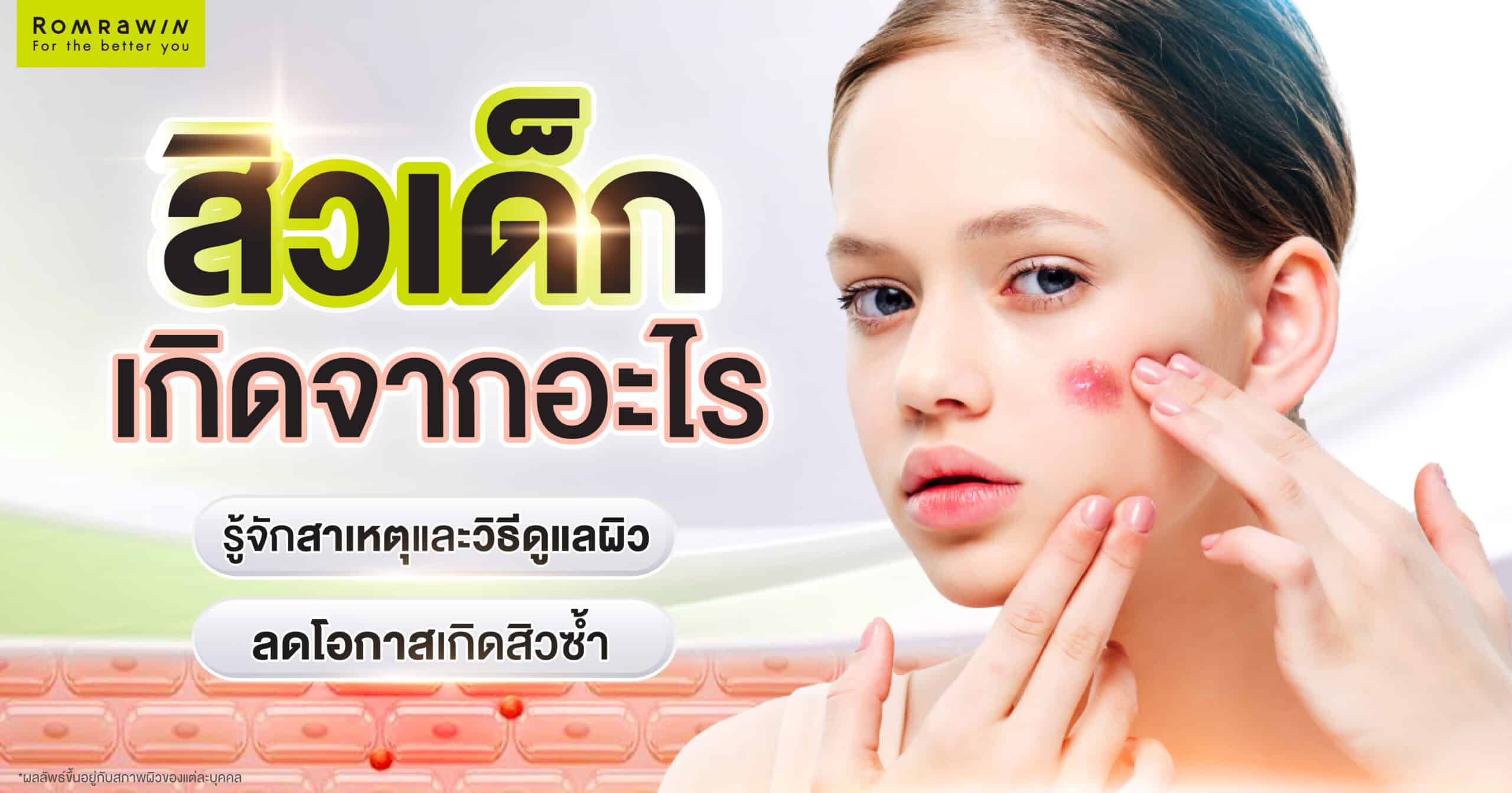 สิวเด็ก