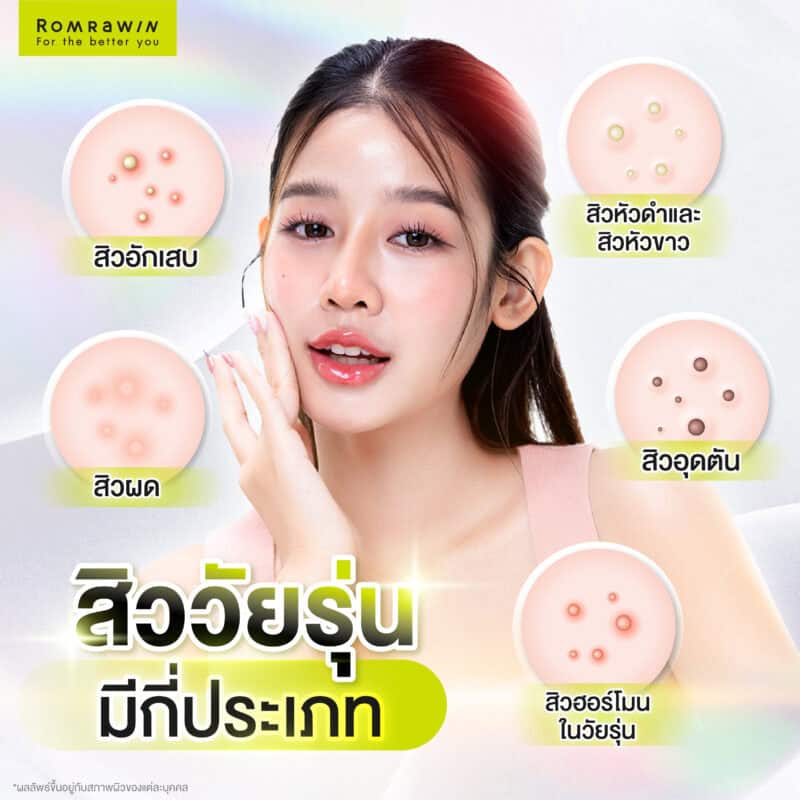 สิววัยรุ่นมีกี่ประเภท