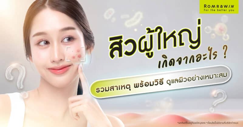 สิวผู้ใหญ่