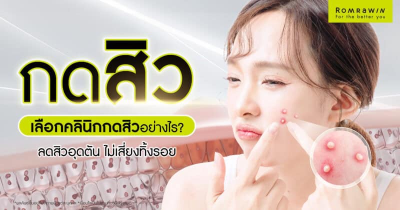 กดสิวที่ไหนดี