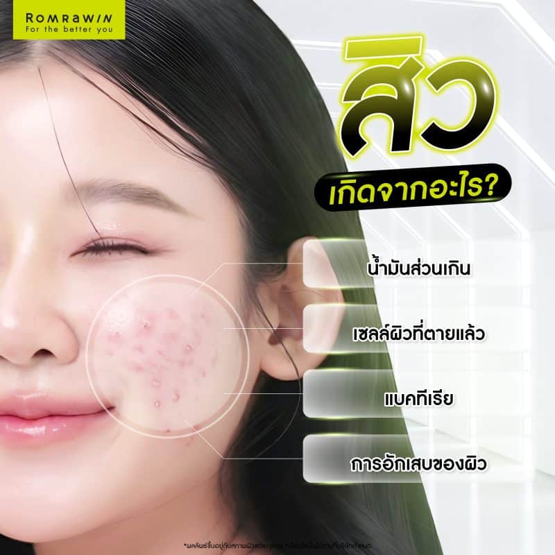 สิวเกิดจากอะไร? เข้าใจต้นเหตุของการเกิดสิว