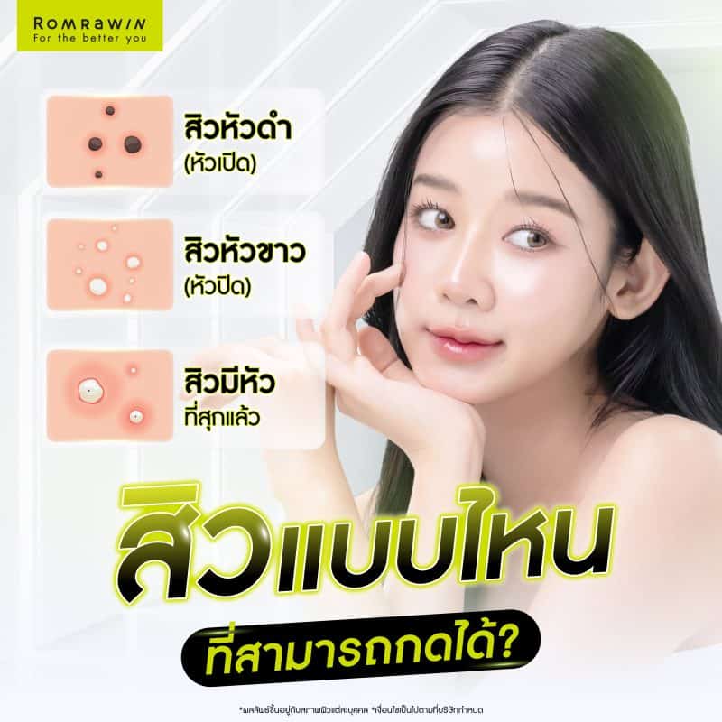 สิวแบบไหนที่สามารถกดได้