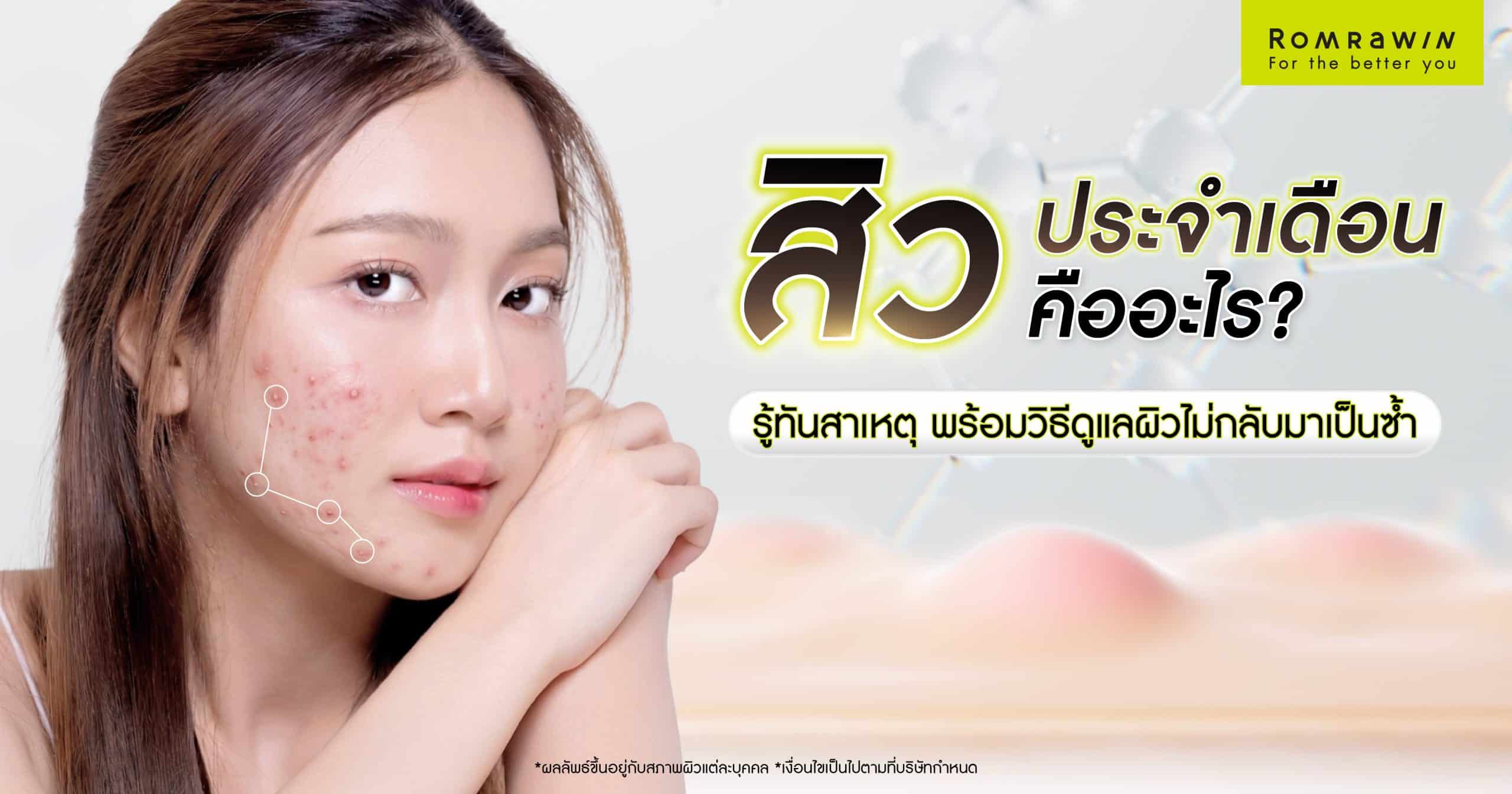 สิวประจำเดือน
