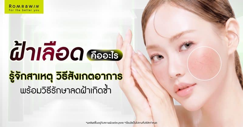 ฝ้าเลือดคืออะไร