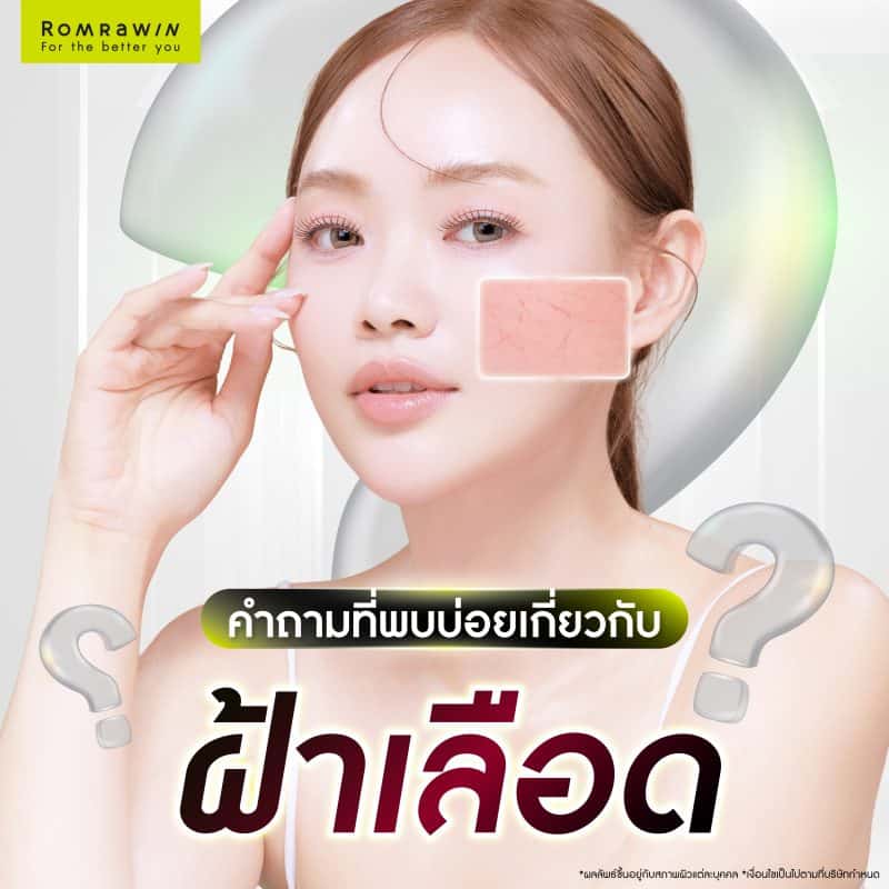 FAQ คำถามที่พบบ่อยเกี่ยวกับฝ้าเลือดคืออะไร